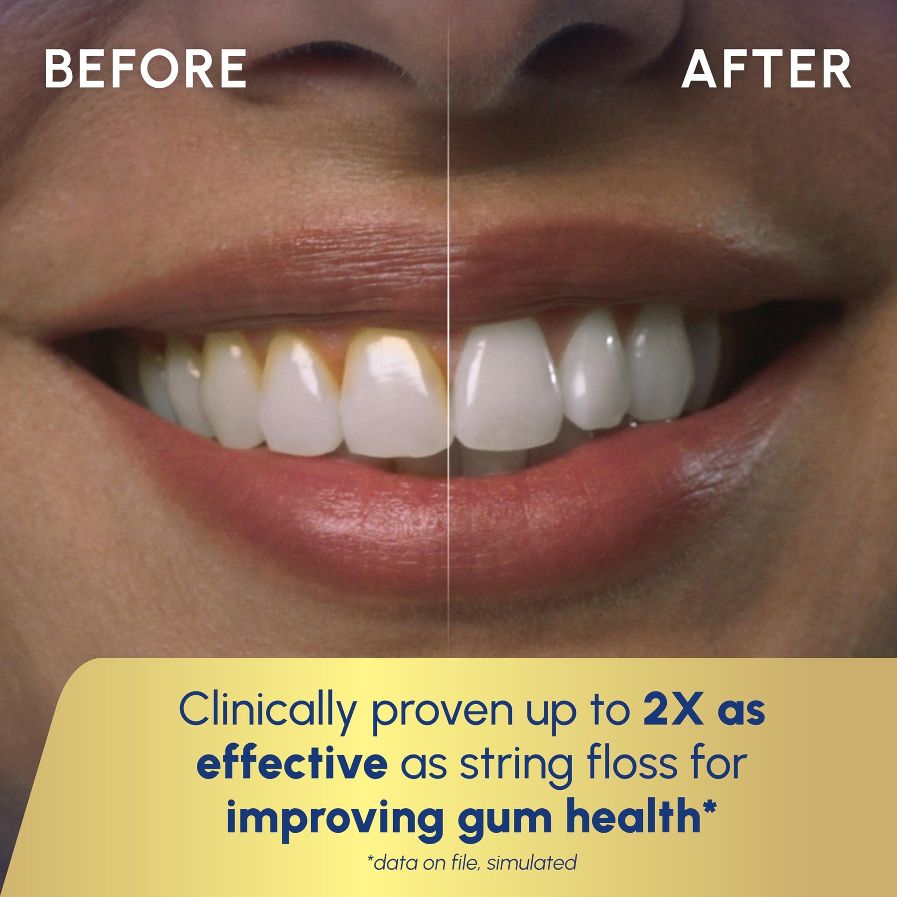 Water Flosser for Teeth Cleaning